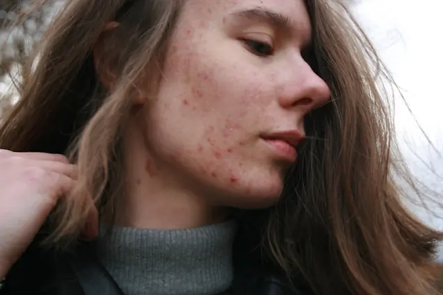 Junge Frau mit sichtbaren Hautirritationen im Gesicht als Bezug zum Evommune-Börsengang und der Behandlung chronischer Entzündungserkrankungen