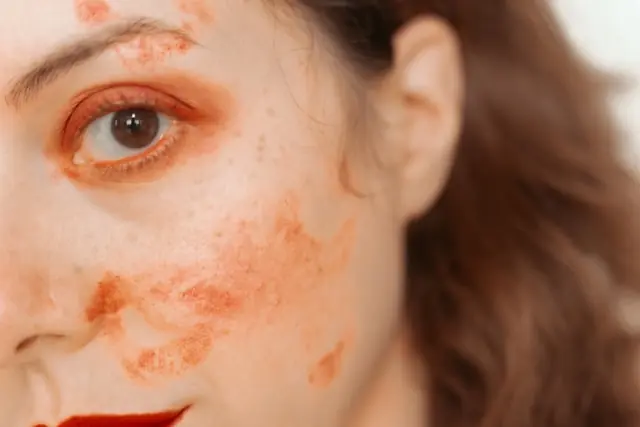 Nahaufnahme eines Gesichts mit rötlichen Hautveränderungen als Bezug zum Börsengang des Dermatologie-Biotechs Evommune